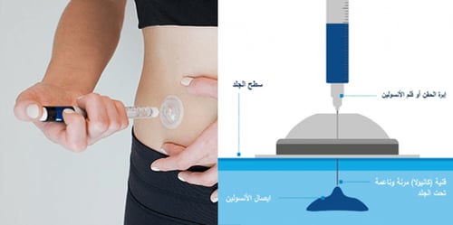 اى بورت ادفانس جهاز حقن الأنسولين 10 قطع من ميدترو...