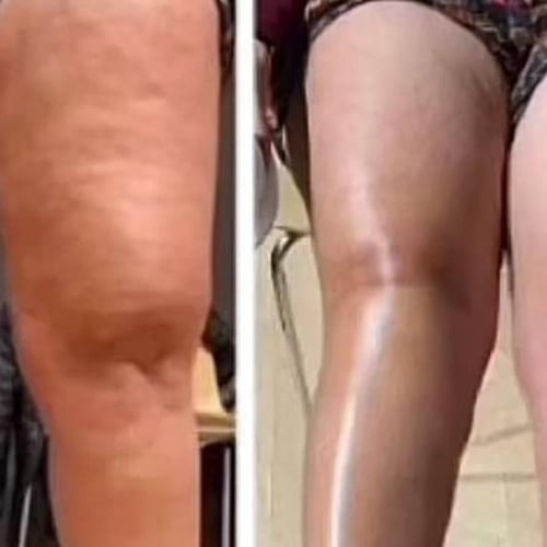 جهاز ازالة السيلوليت