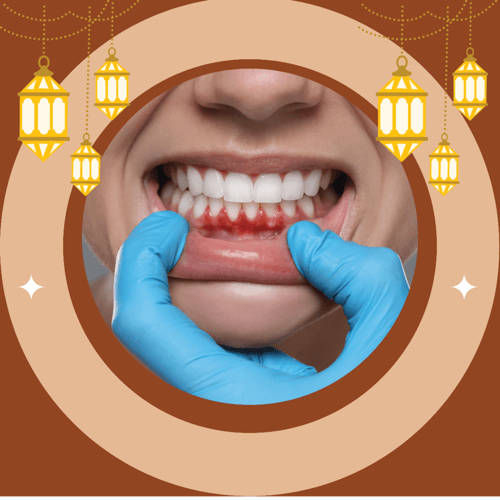 Laser gum trimming for the jaws