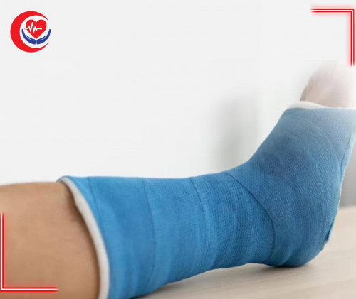 جبس تحت الركبة