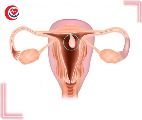 استخراج لحمية كبيرة من عنق الرحم
