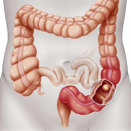 الكشف عن اورام القيلون