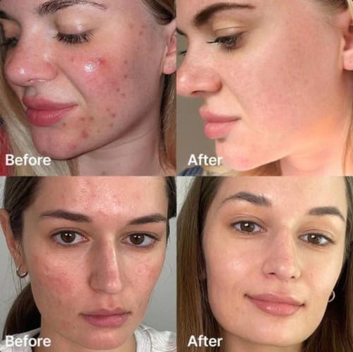 مجموعه الصفاء و النضارة و التحكم بحبوب البشرة و ال...