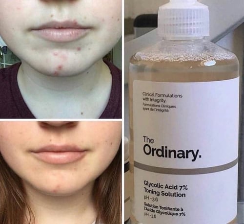 تونر تفتيح البشرة بحمض الجليكوليك 7٪ من ذا اوردينا...