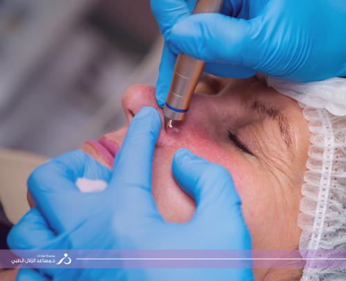 ازالة الشامة بالليزر