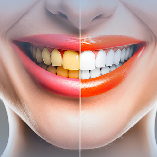 تبييض اسنان قوالب + تنظيف بشرة كلاسيك مجانا