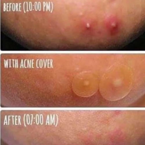 لصقات للوجه المعجزة 30 يوما لعلاج الحبوب والآثار م...