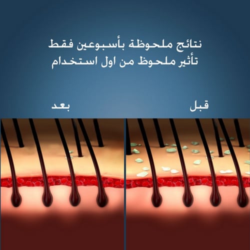 شامبو لعلاج قشرة الشعر والتهاب الجلد الدهني من نيز...