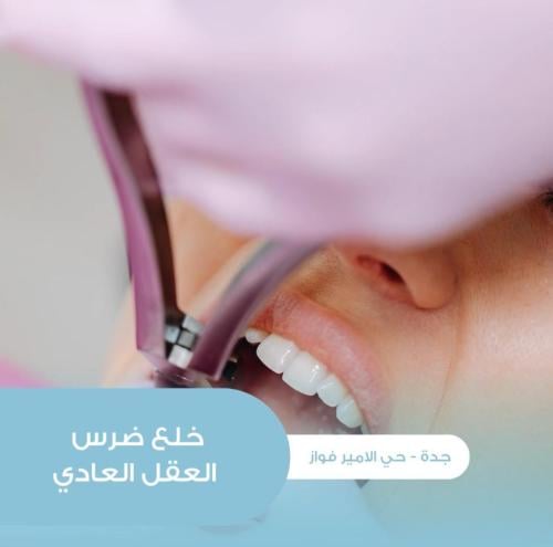 خلع ضرس العقل - بسيط