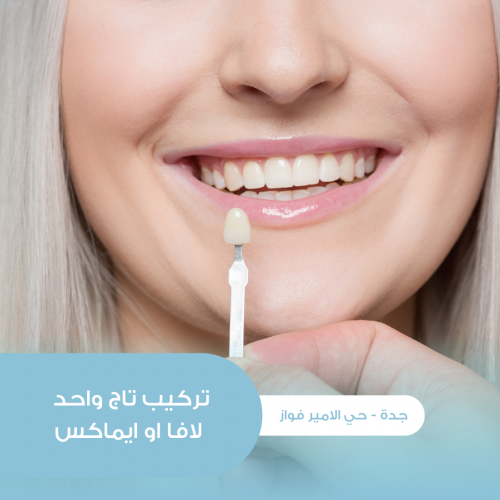 تركيب تاج واحد ايماكس