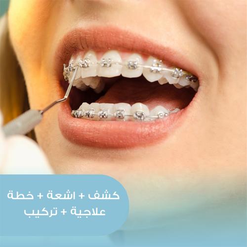 كشف + أشعة + خطة علاجية + تركيب تقويم