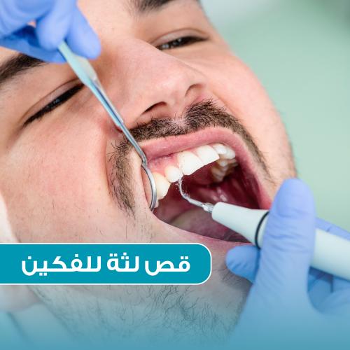 قص لثة للفكين