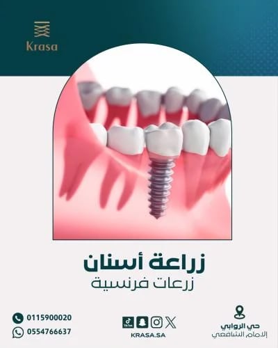 زراعة أسنان فرنسية مع الأشعة مجاناً تبدأ من