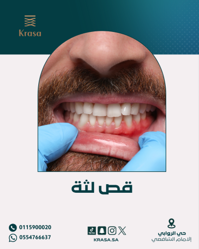 قص لثة بالليزر ( للفكين )