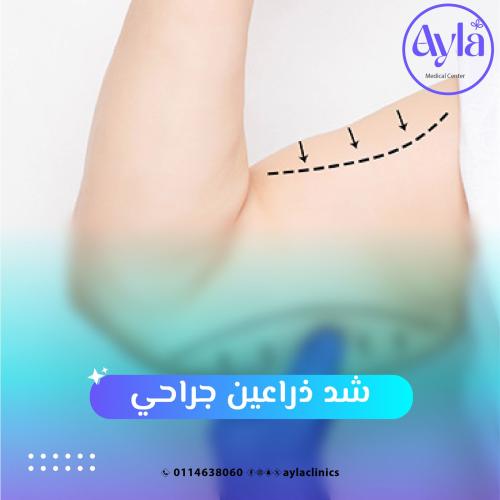 شد ذراعين جراحي