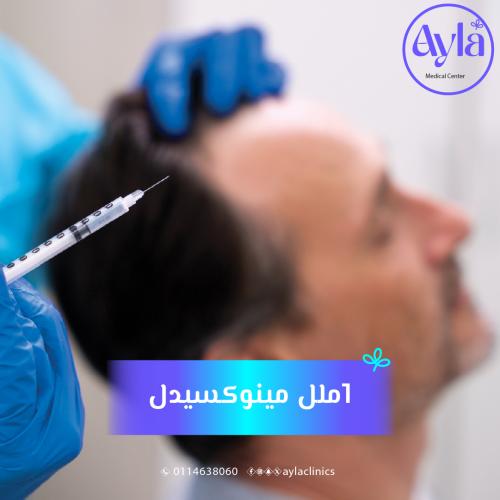 1ملل مينوكسيدل