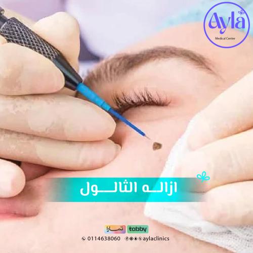 إزالة الثآلول