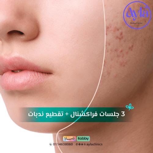 3 جلسات فراكشينال + تقطيع ندبات