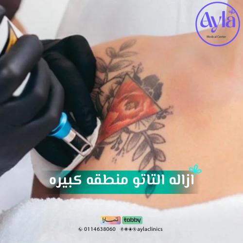 جلسة ازالة تاتو منطقة كبيرة
