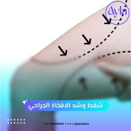 شفط وشد الافخاذ الجراحي