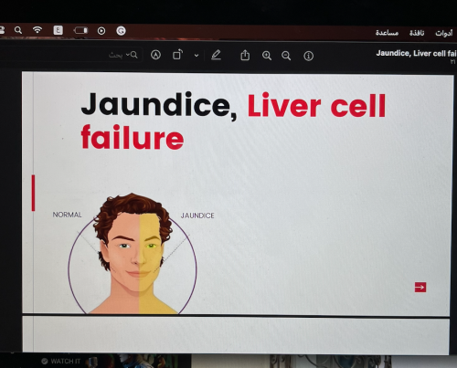 Jaundice, Liver cell failure \ 21 ص