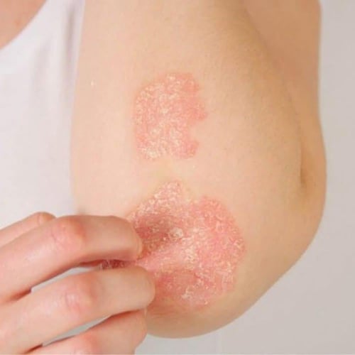 الصنوبر البوسني للأمراض الجلديه والأكزيميا والصدفي...