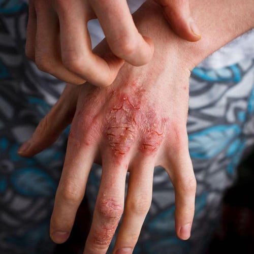 الصنوبر البوسني للأمراض الجلديه والأكزيميا والصدفي...