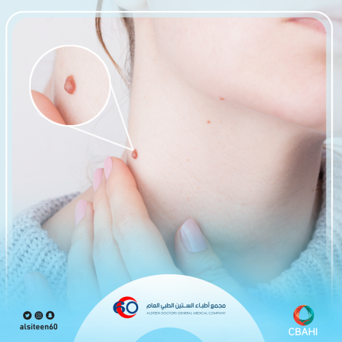 Removal of warts from 2-5
