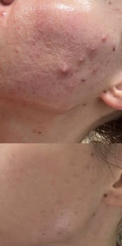 غسول رغوي لحب الشباب بنزويل بيروكسيد 10% من بانوكس...