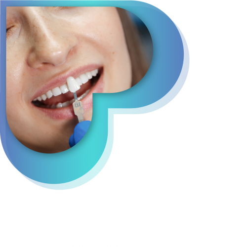 تركيبة أيماكس التجميلية ( للسن الواحد )