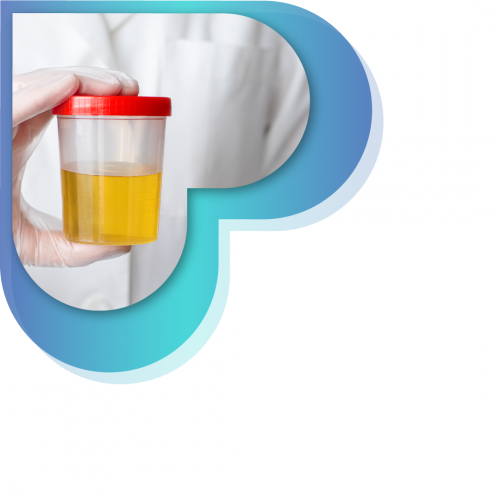 تحليل Lopus anticoagulant