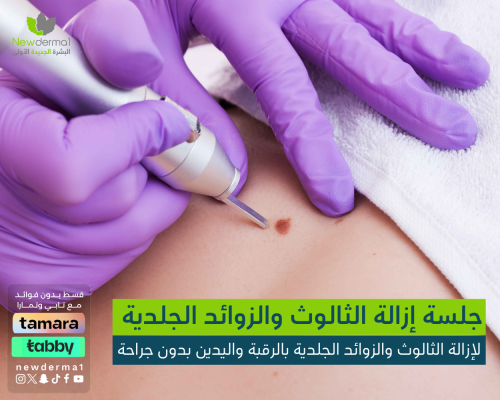 جلسة إزالة الثالوث والزوائد الجلدية بالرقبة واليدي...