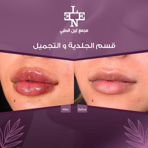 فيلر ارت فيلر