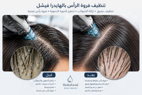 تنظيف فروة الرأس بالهيدرافيشل
