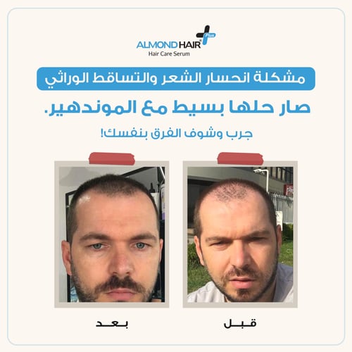 سيروم الموند هير لإنبات الشعر وتقليل التساقط للرجا...