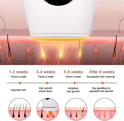 جهاز ازالة الشعر باليزر