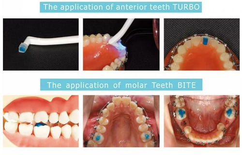 Blue Glue Light-cure Band Cement
