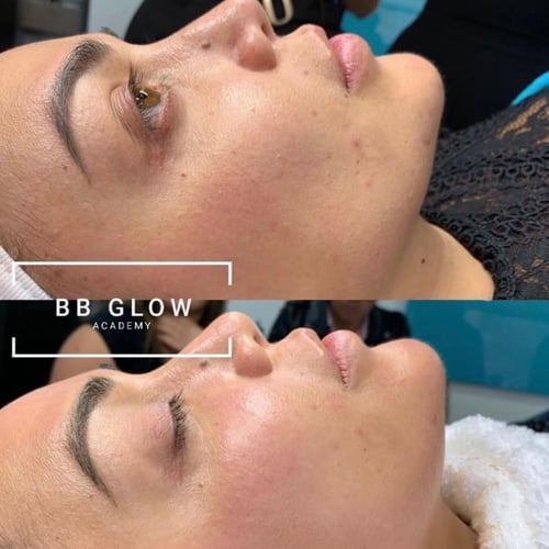 باكج 3 جلسات بيبي قلو للوجه