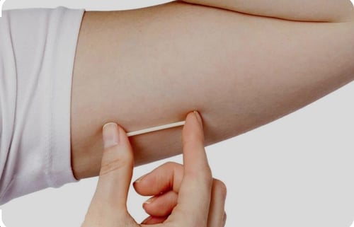 تركيب كبسولة منع الحمل مع الكبسولة