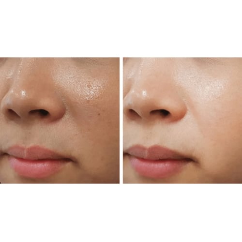 كريم ACM لتفتيح البشرة وإزالة البقع الداكنة والتصب...