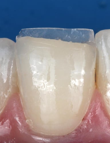 incisal composite flowable (INC)