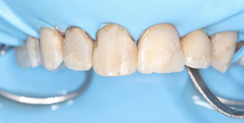 ربر دام الاحترافي rubber dam