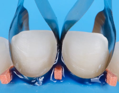 عازل اللثة Liquid Dam