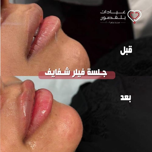 فيلر ستايلج 1 مل للشفايف