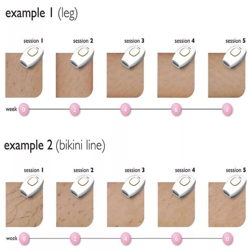 الليزر المنزلي من IPL