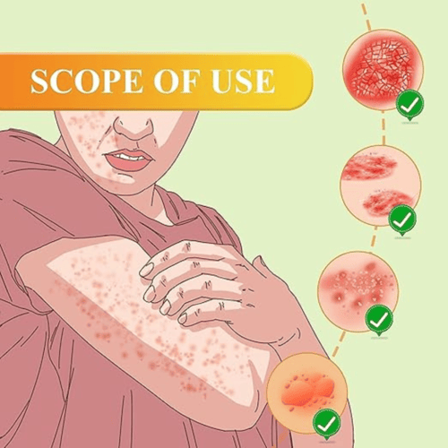 كريم سم النحل للصدفية