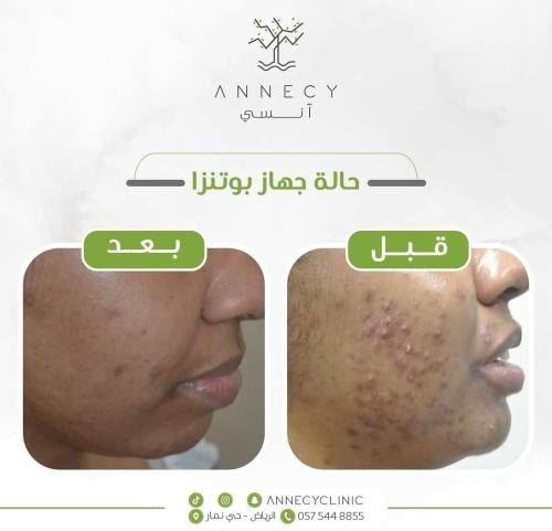 عرض جلسة مايكرو نيدل بجهاز البوتنزا مع محفزات النض...