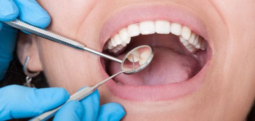 خلع ضرس عقل