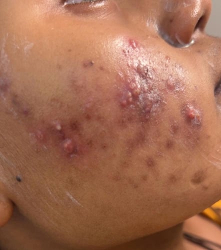 مصحح الهالات والتصبغات الغامقة