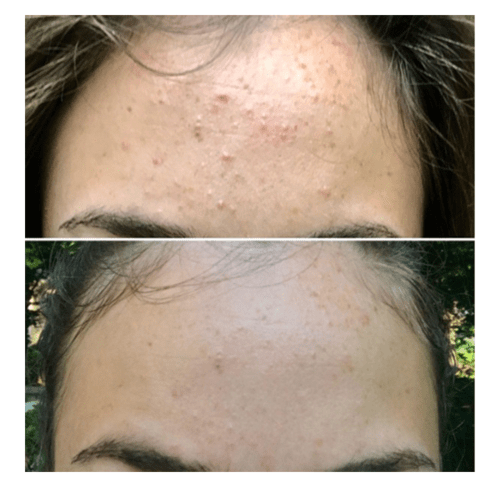 ستريدكس - قطن ناعم الملمس لعلاج حب الشباب 90قطعه